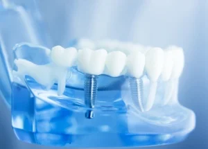 after dental implant placement illustration