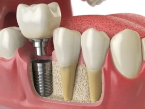 image showing the replacement of a missing tooth with a natural looking implant crown